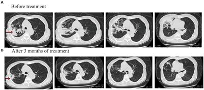 Tuberculosis patients with special clinical conditions treated with contezolid: three case reports and a literature review